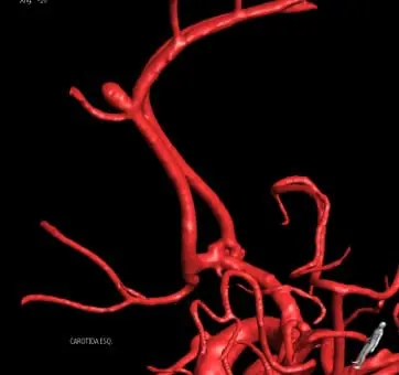 Aneurisma de artéria comunicante anterior - angiografia cerebral