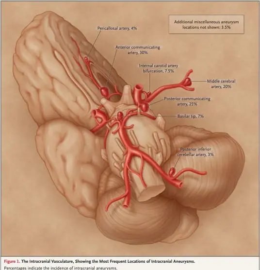 Aneurismas Cerebral