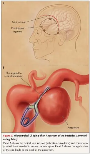 Cirurgia para Clipagem de Aneurisma Cerebral